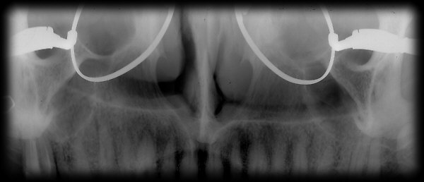 Roentgenbild eines Oberkiefers. Bitte anklicken.
